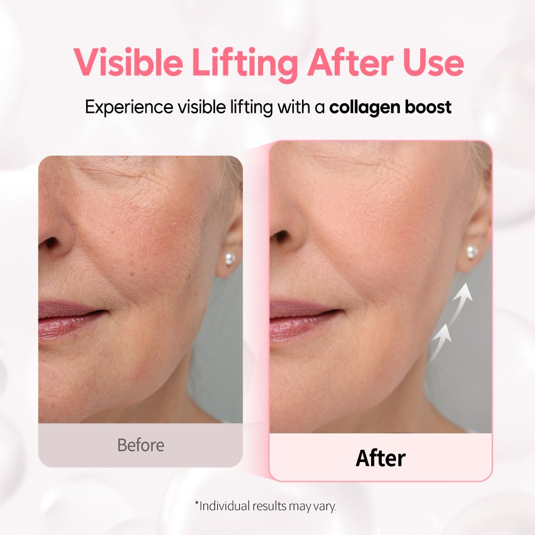 Overnight Collagen Lifting Gel Mask 5 pcs, Korean Face Lifting Deep Hydrogel Mask for Glass Skin, Anti-Aging with PDRN (Salmon DNA), Hyaluronic Acid for Elasticity, Firmness