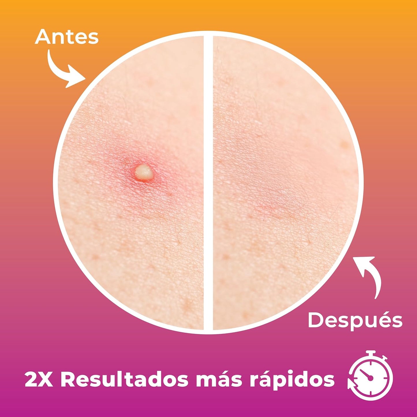 Parches para Acné en la Cara (120 Unidades) Parches Hidrocoloides Transparentes, Parches para Granos, Parches para Espinillas, Parches Faciales para Acné, Parches Antiimperfecciones Rostro